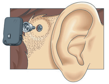 Bone Anchorded Hearing Aid