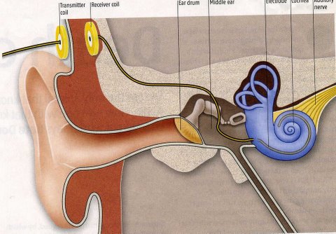 Cochlear Implant